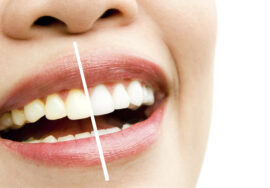 Blanqueamiento dental profesional: beneficios, cuidados y resultados reales