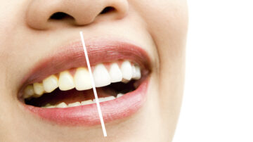 Blanqueamiento dental profesional: beneficios, cuidados y resultados reales